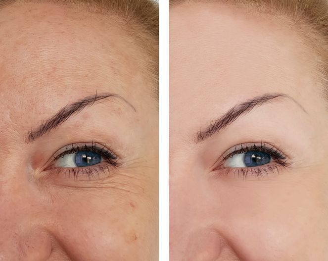 HIFU_Face_lift6_e5ddf49cb2.jpg