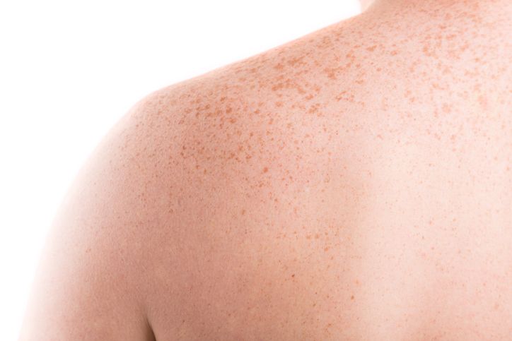 PicoCure Vs. Micro-needling: Which Is Better to Treat Pigmentation?