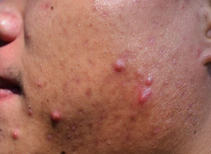 The Best Acne Treatment in Australia To Treat Severe, Cystic Acne!