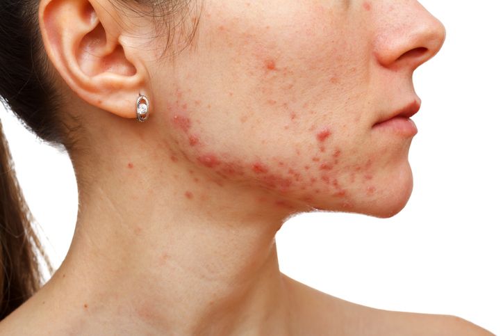 Is The Future of Acne Treatment Leading Towards Non-Surgical Acne Treatment?
