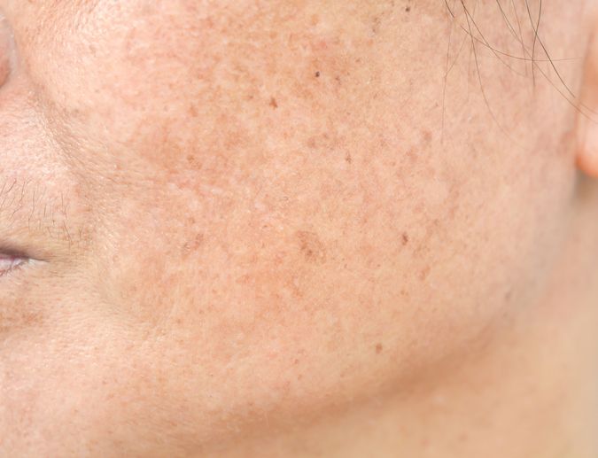 Try Laser Facial For Your Stubborn Pigmentation! l Perfect Laser Clinics