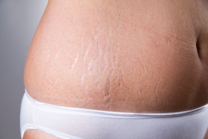 /uploads/laser_treatments_stretch_marks_1_9836d0f945.jpg