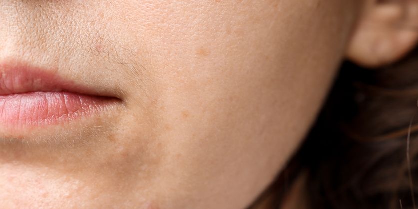 Chin Hair In Women - What It Means And How To Get Rid Of It