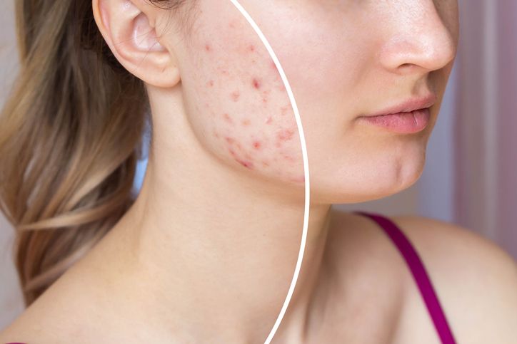 Is Laser Treatment the Right Approach Towards Acne Scar Removal?